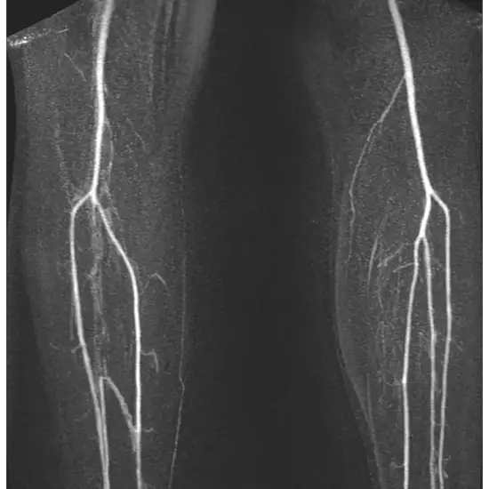 MR Angiography Left Thigh